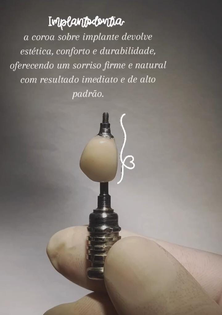 Coroa sobre implante devolvendo estética, conforto e durabilidade ao sorriso