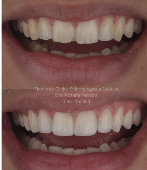 Registro clínico de harmonização estética do sorriso realizada na FKODONTO