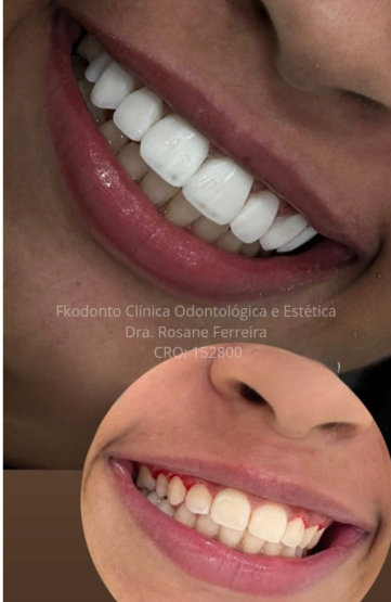 Registro clínico de lentes em resina realizadas na FKODONTO